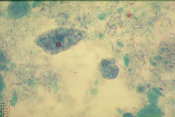 Az ureaplasma és a Trichomonas gyertyái